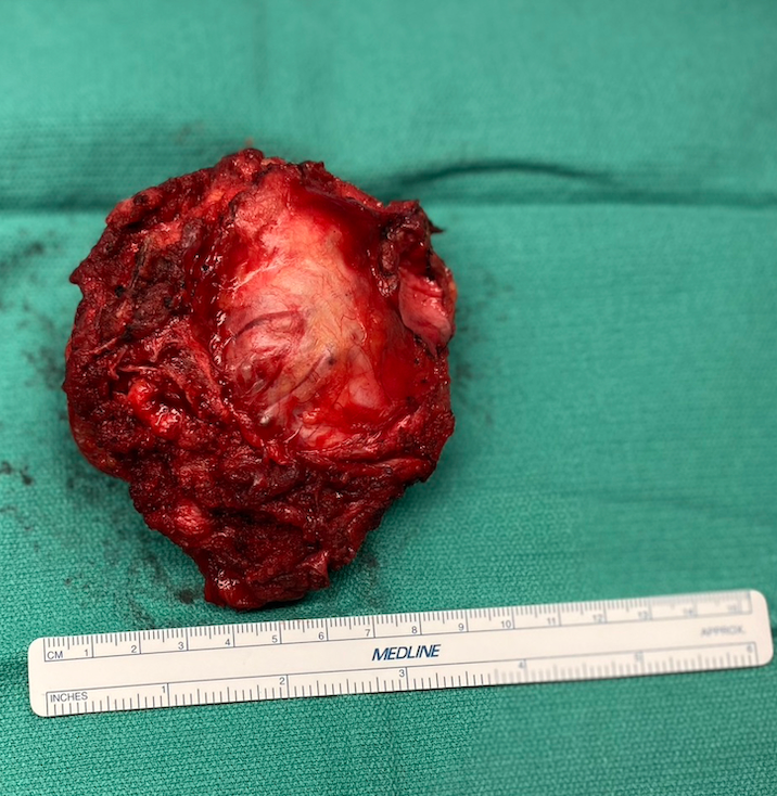 72-year-old patient diagnosed w/ sacral chordoma, a rare #SpineTumor, has successful resection surgery @UNC_Health_Care. #SpinalNeurosurgeons @MGalganoMD & @CheeragU together performed a curative “en bloc” resection: unc.live/3Ul8R1v