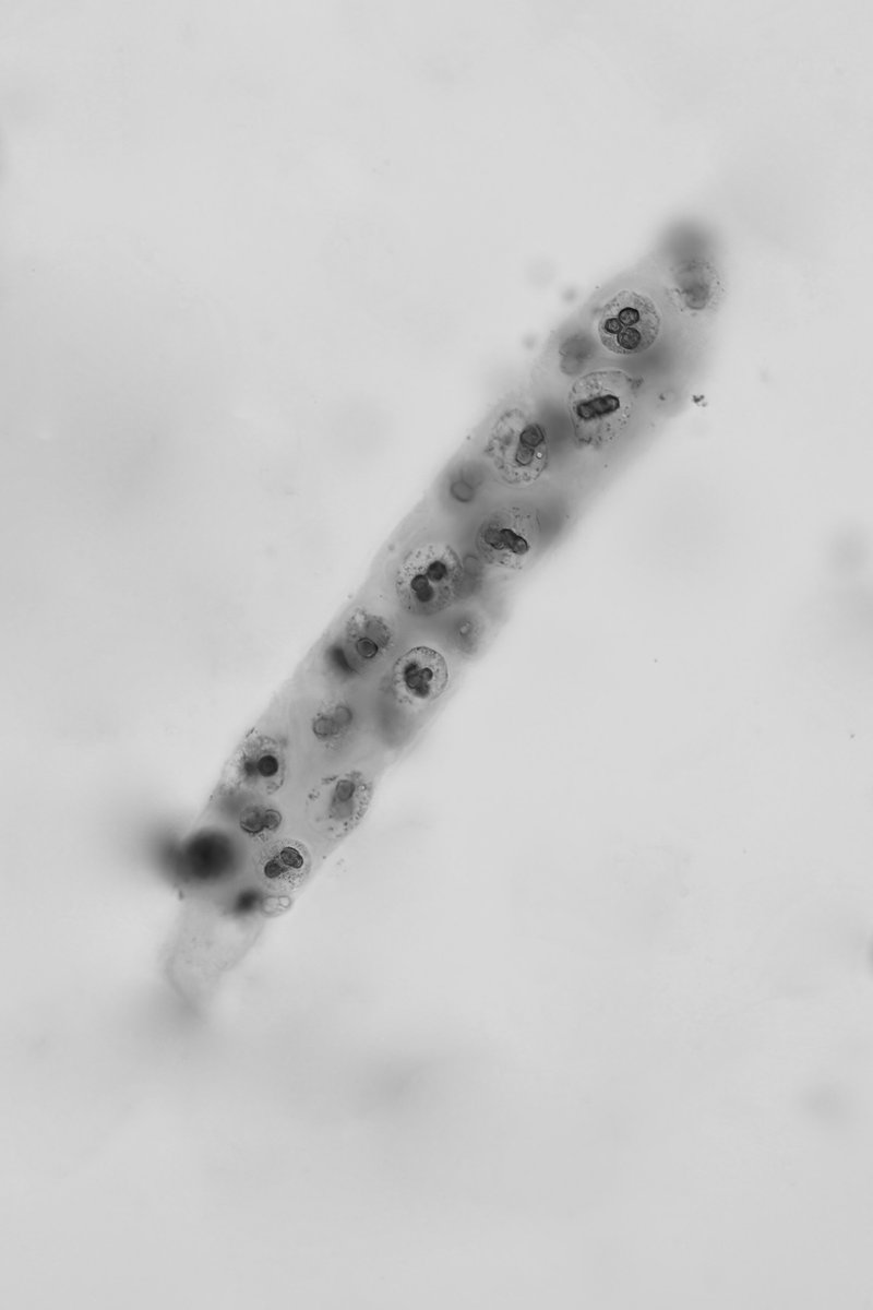 WBC cast  - brightfield with SM stain - converted to grayscale - #UrinarySediment #UrineMicroscopy