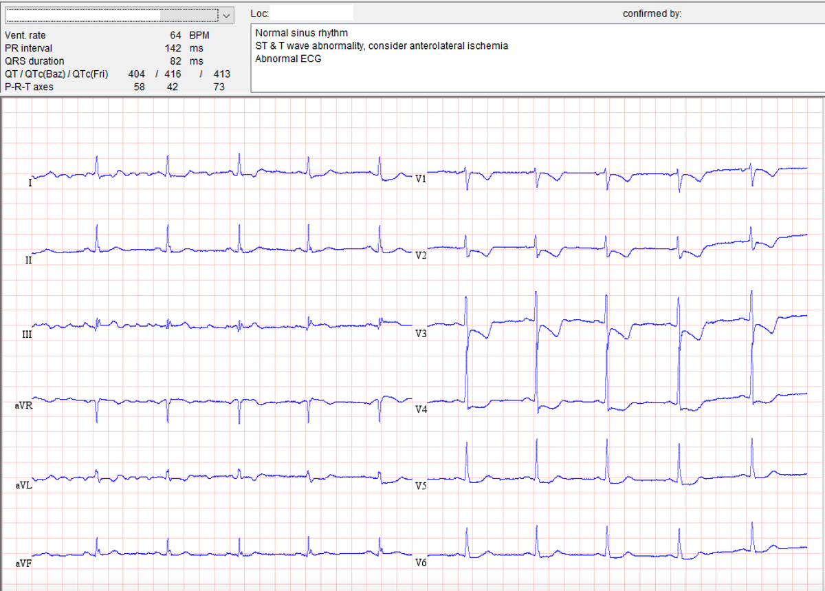 66F, epigastric pain no risk factors. Can there be acute coronary occlusion - without ANY ST-elevation?

Let's have a poll this time - vote below and comment your interpretation &amp; next steps after seeing this #ECG!