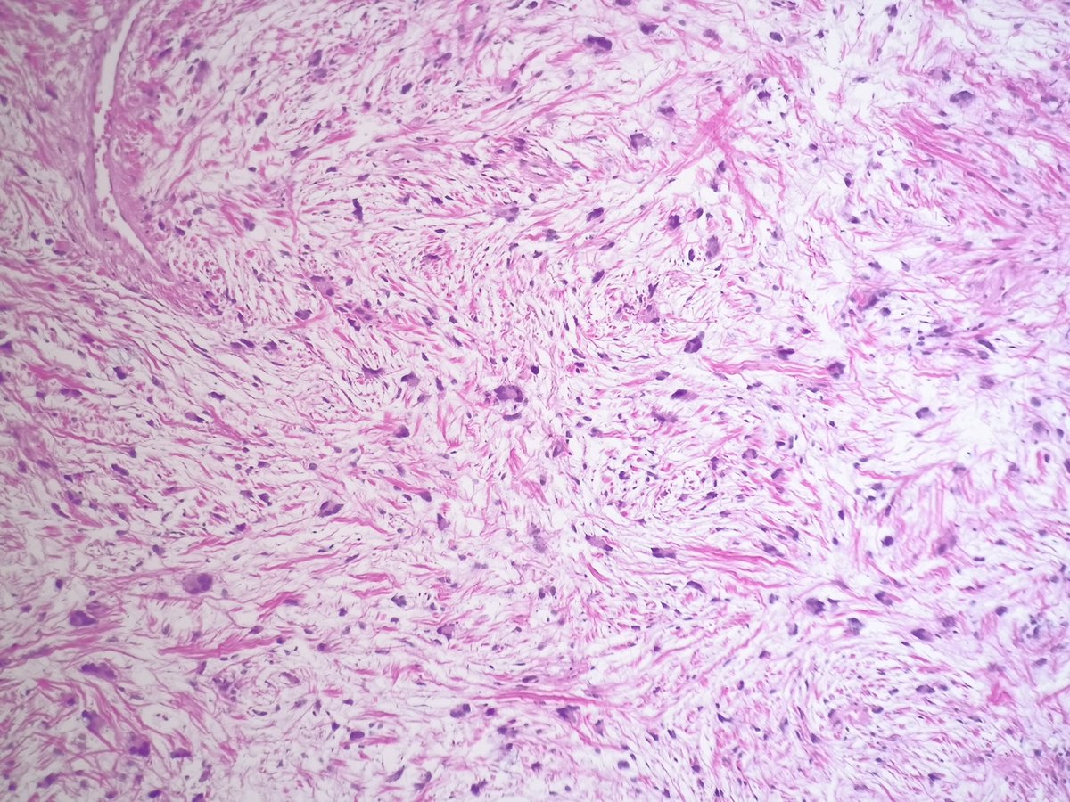 Fat-poor pleomorphic lipoma. ➡️ Notice floret-like multinucleated giant cells 🌸 Next to wiry collagen bundles & bland spindle cells in a 'school of 🐟' growth pattern. Oh, the oximorons of pathology. #BSTPath #PathTwitter