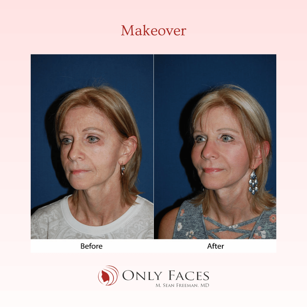 OnlyFacesCLT's tweet photo. This 57-year-old is three months post-op from #CheekImplants, Deep Plane #MiniTuck, and Ablative #CO2 Laser Resurfacing of full face. #Makeover #OnlyFaces https://t.co/F9QnAmpawD