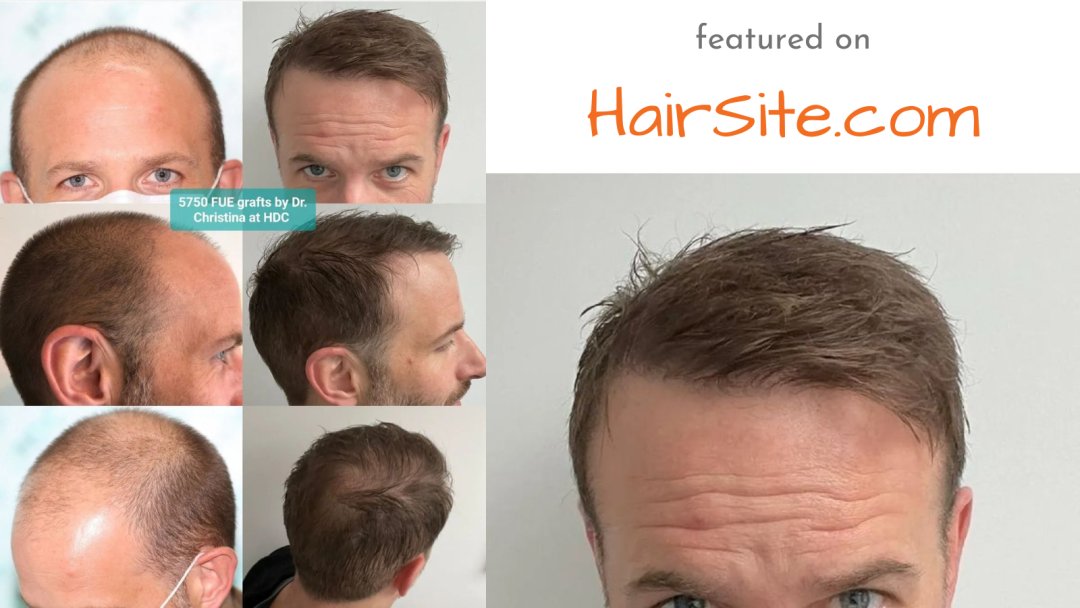 sponsored - HDC clinic 5750 grafts hair transplant. Click bit.ly/3VQc8n3 for free consultation &cost estimates with up to 20 clinics worldwide. #MAGACult #Melania #Cardoso #Raven #Boeing $SCHRO #BitcoinHalving2024 #TOTNFO #ShuChe #THFC #weareoneEXO #solar #JONGHYUN