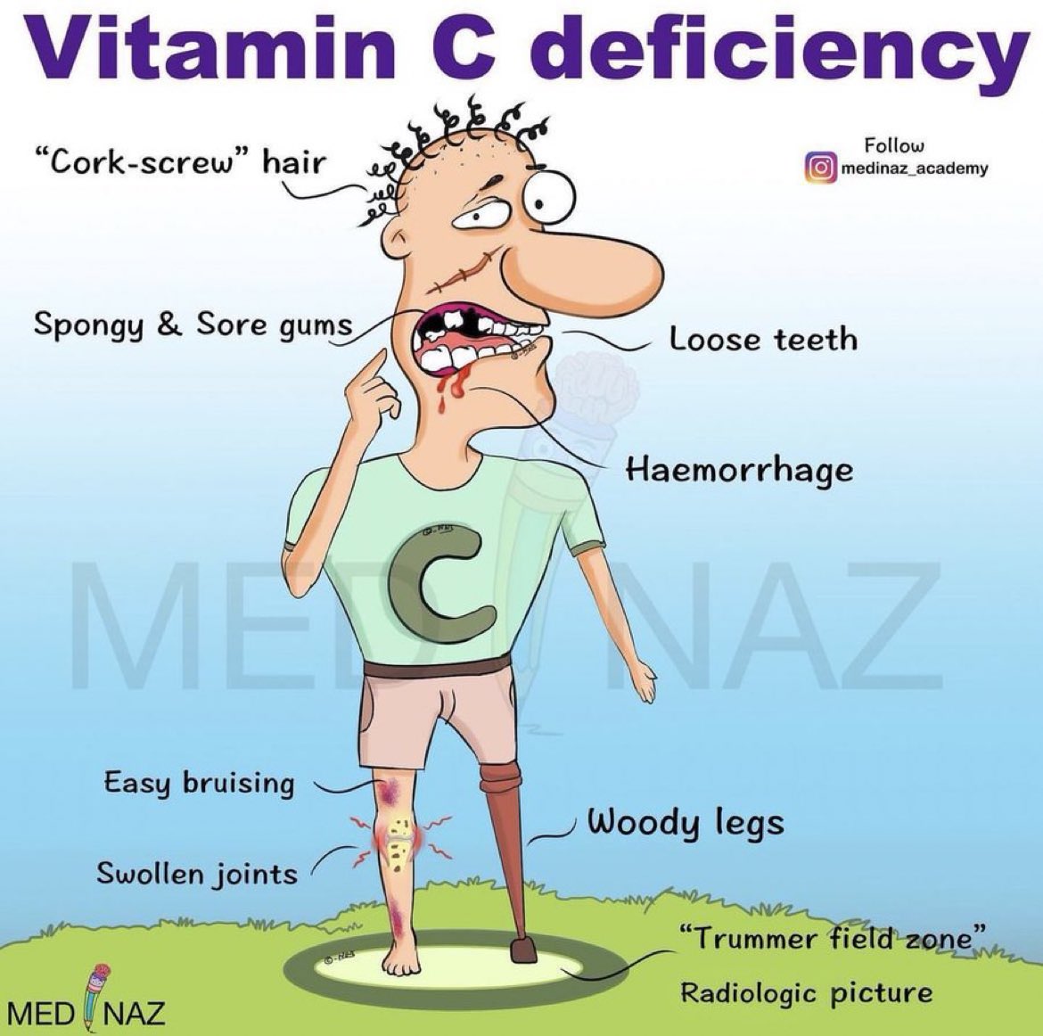 Vitamin C deficiency #MedEd #FOAMed #Vitamins #Nutrition #Dietitian Credit: medinaz_academy