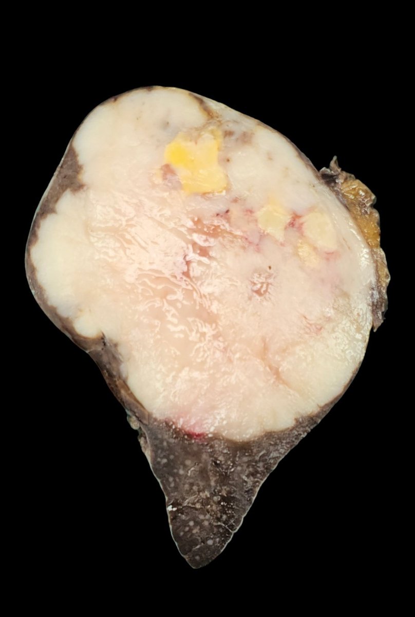 Drmerm's tweet image. A 59-year-old female. spleen mass
#PathTwitter #pathology  #medpath #MedTwitter #xpath #pathtweetaward #GIpath #pathology #PathTwitter #hemepath