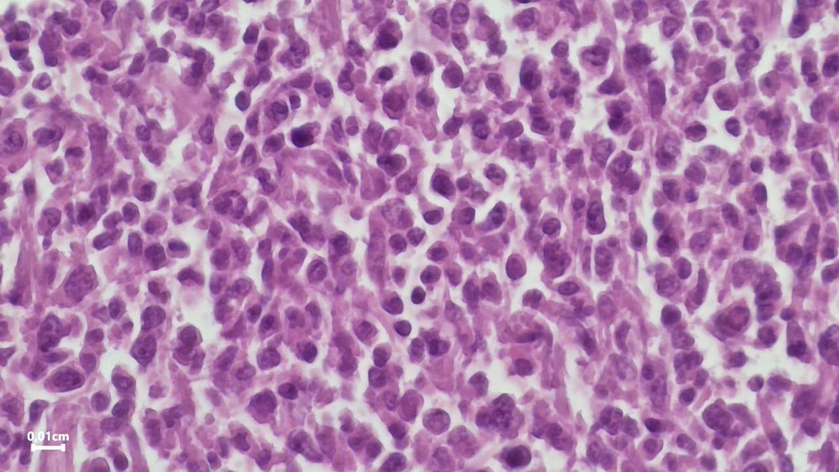 Drmerm's tweet image. A 59-year-old female. spleen mass
#PathTwitter #pathology  #medpath #MedTwitter #xpath #pathtweetaward #GIpath #pathology #PathTwitter #hemepath
