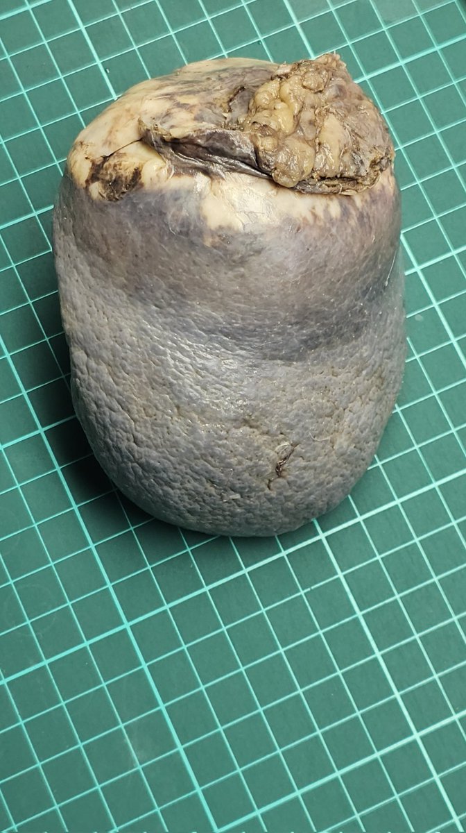 Drmerm's tweet image. A 59-year-old female. spleen mass
#PathTwitter #pathology  #medpath #MedTwitter #xpath #pathtweetaward #GIpath #pathology #PathTwitter #hemepath