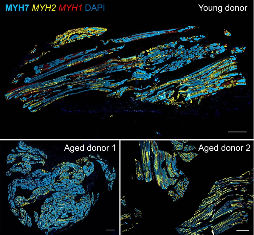 Are you a fan of atlases? 🗺️ Then add this human skeletal muscle aging atlas to your list. @NatureAging | go.nature.com/4420ueC