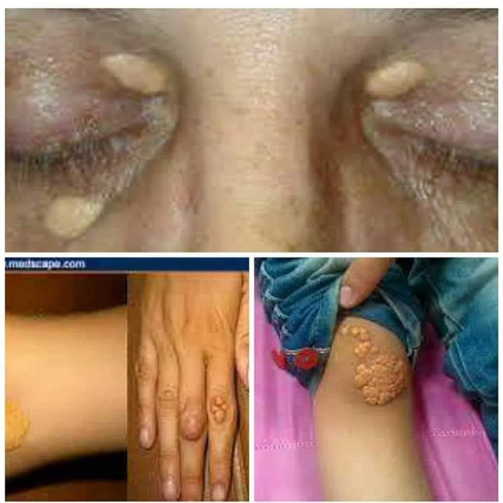 hemo_shk's tweet photo. What is the diagnosis?
#MedEd
#MEDHM
#MedX
@IhabFathiSulima https://t.co/Hde8p5aw6x
