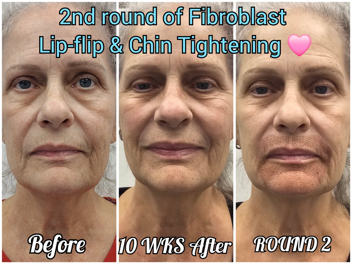 10 weeks later we did a another round of Fibroblast for a Lip-flip and Chin Tightening. 

#lipflip #chintightening #resurfacing #skintreatment #Fibroblast #fibroblastlipflip