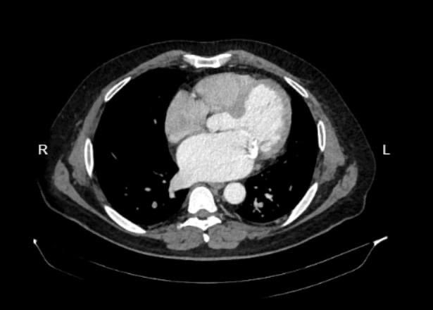 #case 

- 60-year-old male with progressive dysphagia

What are the findings ?
What is the diagnosis?

#Radiology
#CTscan

#MedEd 
#MEDHM 
#MedX 
@IhabFathiSulima