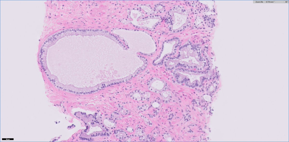 #GUpath prostate bx: nice example of 'microcystic' pattern prostate ca ✔️luminal accentuation (what I call 'eyeliner' sign) sometimes helpful🔬clue pathologyoutlines.com/topic/prostate… @Pathoutlines