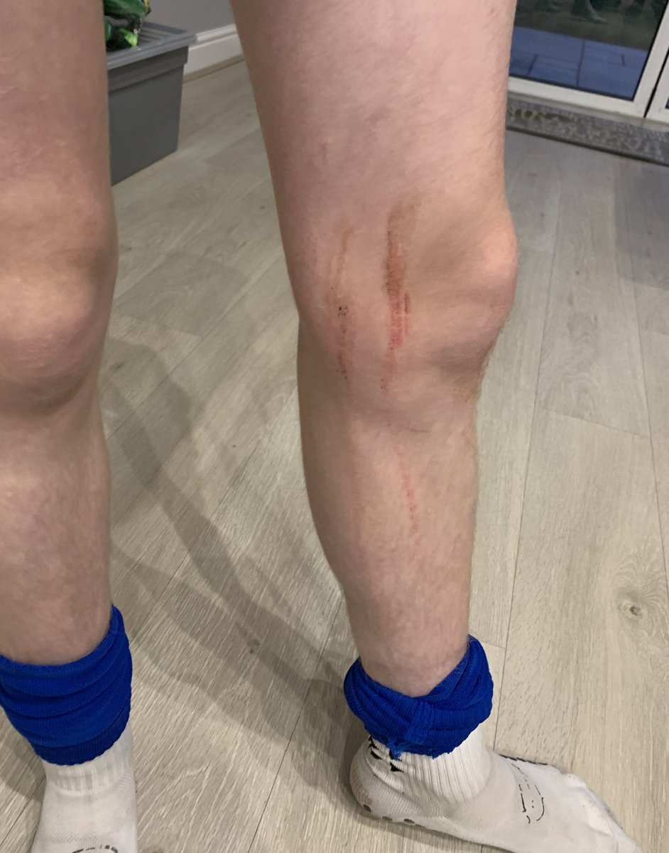 AlexBennettUK's tweet photo. A comfortable 1-4 win for @longlevensafc u15 Sunday team away at Tewkesbury in the CYFL. Goals for Theo (2), Aayaan and MOM Alex capped a solid performance across the team. A few battle scars picked up in the process 👍🏼⚽️🔵⚫️ https://t.co/7g6l0J6fAY