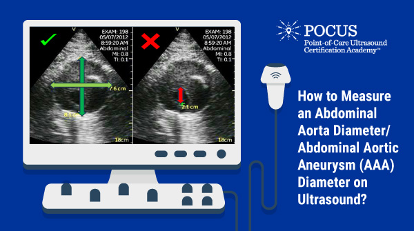 Abdominal ultrasound is the screening modality of choice for abdominal aortic aneurysm because of low cost, no ionizing radiation, a very high specificity of 100% and a high sensitivity of 95-100%. Read our post to learn how to correctly measure an AAA 👉 bit.ly/3W6Me2f