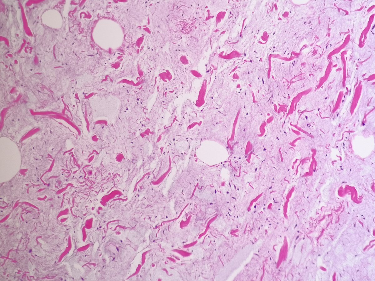 Another example of spindle cell lipoma, rich in myxoid stroma.
➡️ Ropy collagen
➡️ Bland spindle cells (haphazardly/fascicular 'school of fish' arrangement)
➡️Adipocytes of varying sizes
💎Lipoblasts may be seen

#IHCpath CD34+++, nuclear Rb1 loss. 🚫 MDM2 amplif.

#BSTPath