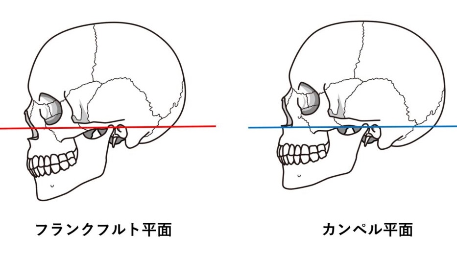 骨の位置、もっというと骨の角度で心がガラリと変わるのをたくさんみて来た。昔は顎を引くことが良いと言われていたけれど、これをするとネガティブになる（笑）これはフランクフルト平面といって耳の穴と目の下を結んだ線を水平にした頭のポジション。…