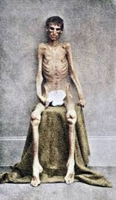 Colorized photo of a survivor of the American Civil War. The image specifically shows emaciated Union soldier upon his release from the Confederate prison Camp Sumter, located in Andersonville, Georgia. 

Of the approximately 45,000 Union prisoners held at Camp Sumter during the