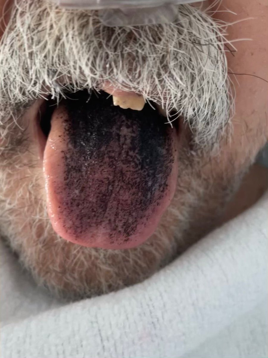 Black Hairy Tongue / Lengua Negra Vellosa 

Afección no muy frecuente, pero que puede estar asociada al uso de antibióticos. En este caso, meropenem.

#antimicrobialstewardship
#PROA

(📸publicada con consentimiento expreso)