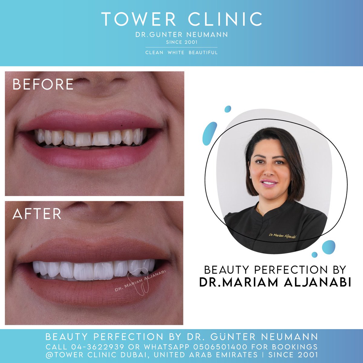 Beauty Perfection By Dr.Mariam Aljanabi ✨
Please call 04-3622939 or WhatsAPP 0506501400 for bookings.
#Dubai #Dental #Dentist #Teeth #Clinic #TowerClinic #DubaiDentist #DubaiClinic #DentalHealth #OralCare #DentistVisit #DentalCheckup #OralHygiene #TeethCleaning #DentalCare