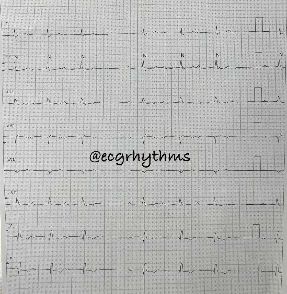 042524
From the 📦

What is the rhythm?

#FOAMed 
#MedEd 
#CardioTwitter 
#Epeeps