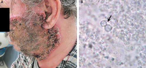 65 años ♂️, Virgina (US), derrame pleural previo y una masa en la língula: 10 meses de una gran placa facial en expansión (A).

Raspados cutáneos: levadura en gemación de amplia base (B, flecha)
1/3

DOI: 10.1056/NEJMicm1204813
 #Micosis #dermatología