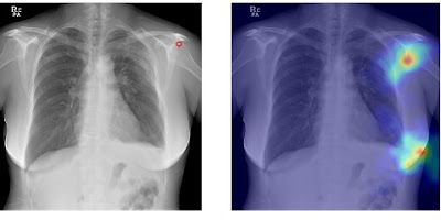 AI-assisted Analysis to Facilitate Detection of Humeral Lesions on Chest Radiographs doi.org/10.1148/ryai.2… #CXR #FPAR #AI