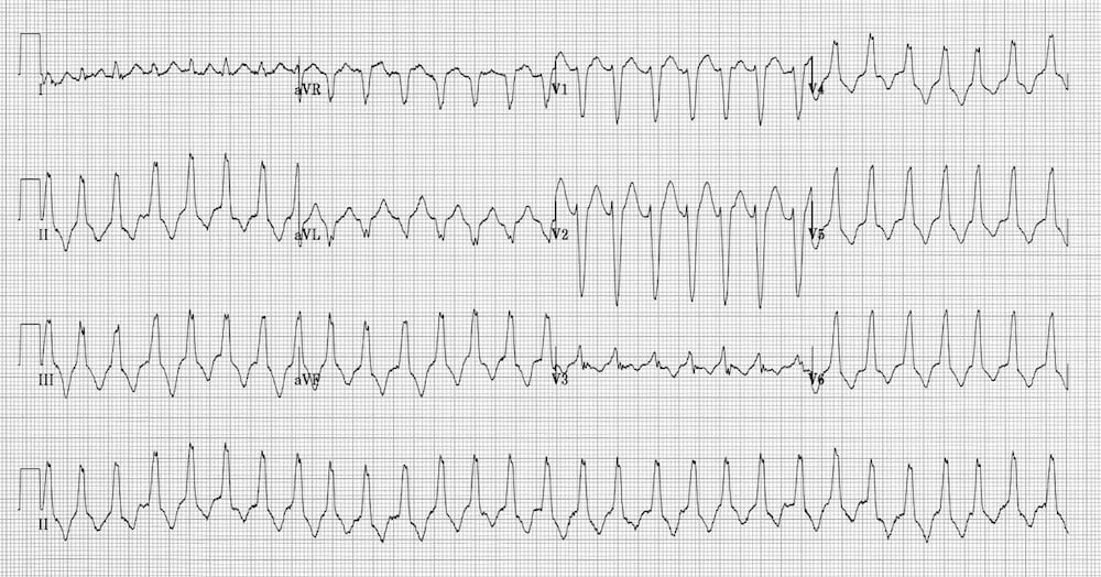 LITFLblog's tweet photo. From the soccer field to the ER: A young player's syncope reveals a shocking ECG. How did a game of soccer end in a fight for life?? https://t.co/I5ukZJJ44T
#FOAMed #MedTwitter #CardioTwitter #MedEd https://t.co/DrHbeWlRDn