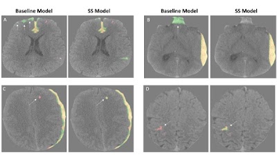 Semisupervised Learning for Generalizable Intracranial Hemorrhage Detection and Segmentation doi.org/10.1148/ryai.2… @UCSFimaging #NeuroRad #DeepLearning #AI