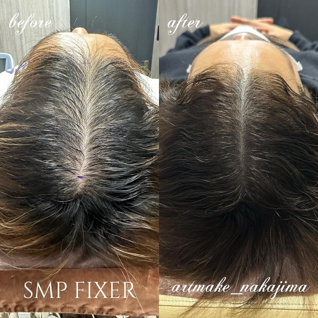 ClairClinic's tweet photo. FIXER症例
【男性・30代・分け目の症例⠀】

┈┈┈┈┈┈
3回コース
10×10cm
┈┈┈┈┈┈
新潟よりご来院して下さった患者様😊
髪の毛が細く、柔らかく
頭皮の透け感が
ずっと気になっていた患者様🙌゜
こちらのFIXERならバレずに自然に気になる部位をカモフラージュできます☽･:*
お気軽にご相談くださいませ💁‍♀️

＃薄毛 
＃薄毛治療 
#新宿美容皮膚科 
#医療アートメイク
#頭皮アートメイク
#新宿クレアクリニック 
#クレアクリニック