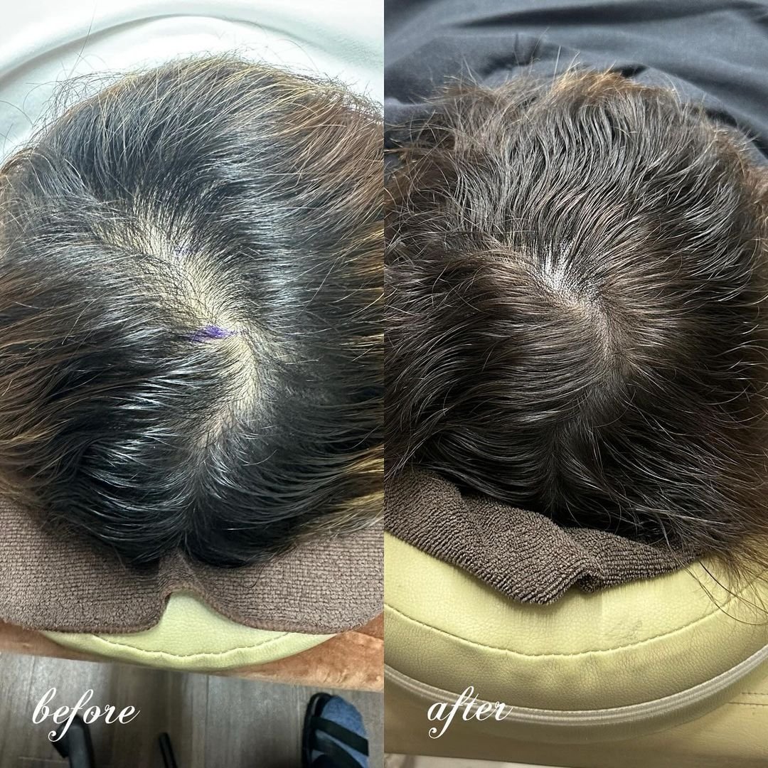 ClairClinic's tweet photo. FIXER症例
【男性・30代・分け目の症例⠀】

┈┈┈┈┈┈
3回コース
10×10cm
┈┈┈┈┈┈
新潟よりご来院して下さった患者様😊
髪の毛が細く、柔らかく
頭皮の透け感が
ずっと気になっていた患者様🙌゜
こちらのFIXERならバレずに自然に気になる部位をカモフラージュできます☽･:*
お気軽にご相談くださいませ💁‍♀️

＃薄毛 
＃薄毛治療 
#新宿美容皮膚科 
#医療アートメイク
#頭皮アートメイク
#新宿クレアクリニック 
#クレアクリニック