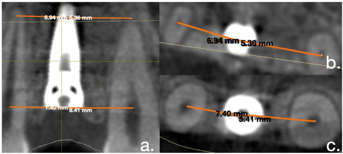 📢 Read our Highly Cited Papers 📚 Evaluation of Deviations between Computer-Planned Implant Position and In Vivo Placement through 3D-Printed Guide: A CBCT Scan Analysis on Implant Inserted in Esthetic Area 🔗 mdpi.com/2076-3417/12/1… 👨‍🔬 Mario Caggiano et al. #openaccess