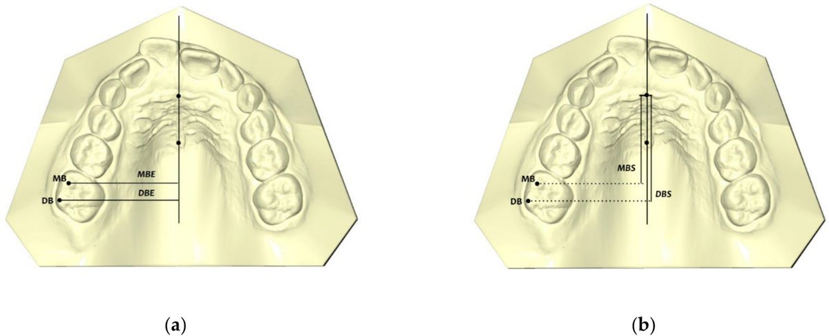 📢 Read our Highly Cited Papers 📚 The Efficacy and Predictability of Maxillary First Molar Derotation with Invisalign: A Prospective Clinical Study in Growing Subjects 🔗 mdpi.com/2076-3417/12/5… 👨‍🔬 Roberta Lione et al. #openaccess