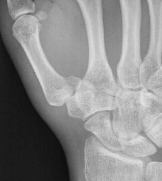 Name the injury, propose the treatment and explain the reason for your choice! #FOAMed #MedEd
