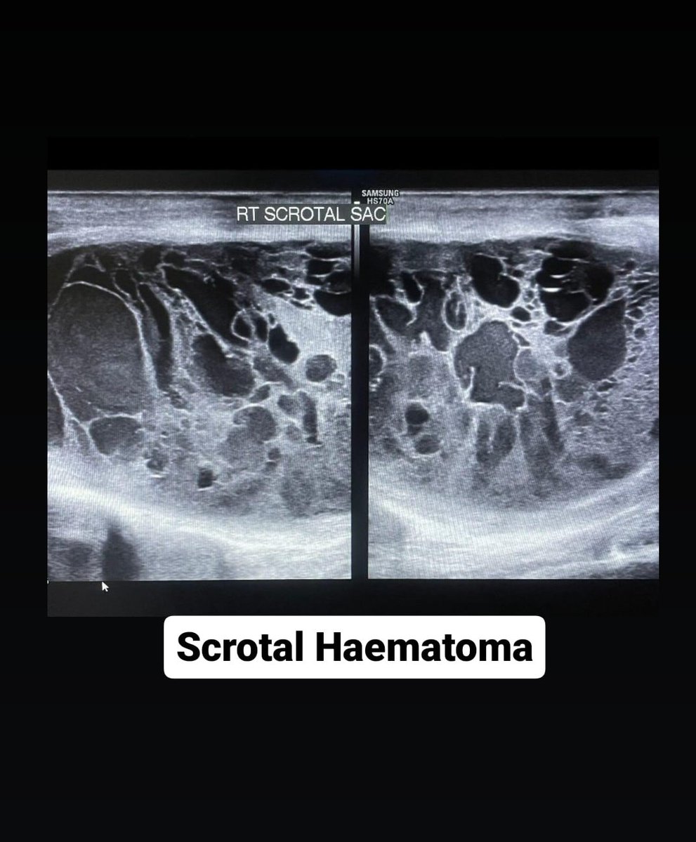 Huge complex collection with septa in right scrotal sac post inguinal hernia repair surgery . Turned out to be a Haematoma . Scrotum wasn't kept elevated . #postop #scrotum #ultrasound #foamrad