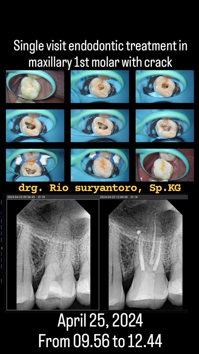 Single visit endodontic treatment in maxillary 1st molar with crack
April 25, 2024
From 09.56 to 12.44

#endodontics #endodontist #rootcanaltreatment #doktergigi #spesialiskonservasigigi