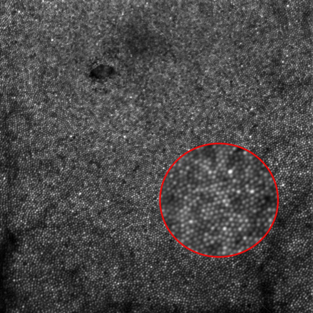 RobotrakVision's tweet image. 0.7μm digital resolution, amazing images acquired with Robotrak Mona AO-SLO! 
Follow us and explore the Adaptive optics retinal imaging system.
Looking forward to meeting you at Booth 1244, #ARVO2024 #Seattle, 5-9 May 2024!#Ophthalmology