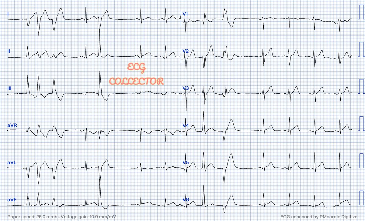 30 year old gentleman; smoker; acute onset chest pain; VS stable.

What do you think❓🤔OMI❓

@PMcardioApp 
#CardioTwitter 
#MedX 
#MedicalStudent