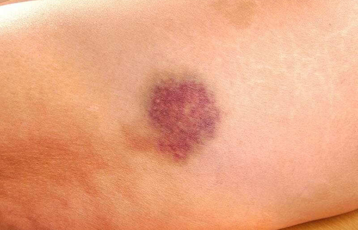 الكدمات الشائعة في النساء ليست جلطة وليست من الضغوط النفسية  كما يدّعي البعض.
ومن أسبابها:
١.اصطدام لا يتذكره الشخص
٢.نقص الصفائح
٣.زيادة السيولة
٤.بعض الأدوية: اسبرين،بلافيكس،كورتيزون.
٥.نقص فيتامين سي.