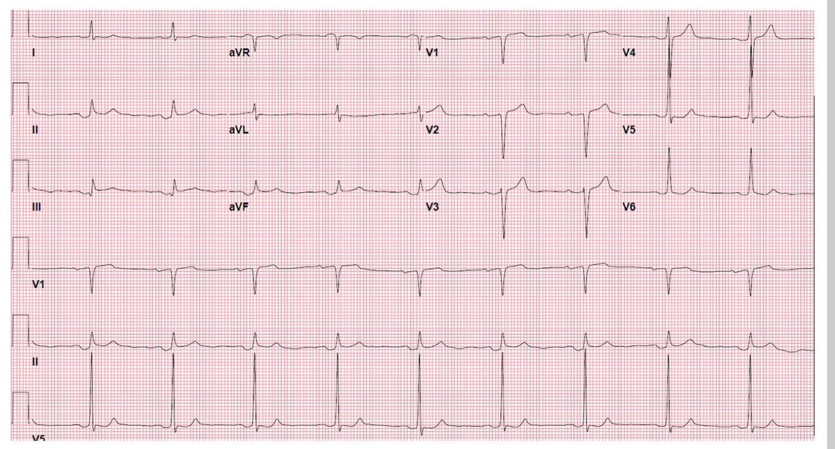 ecgandrhythmRoe tweet picture