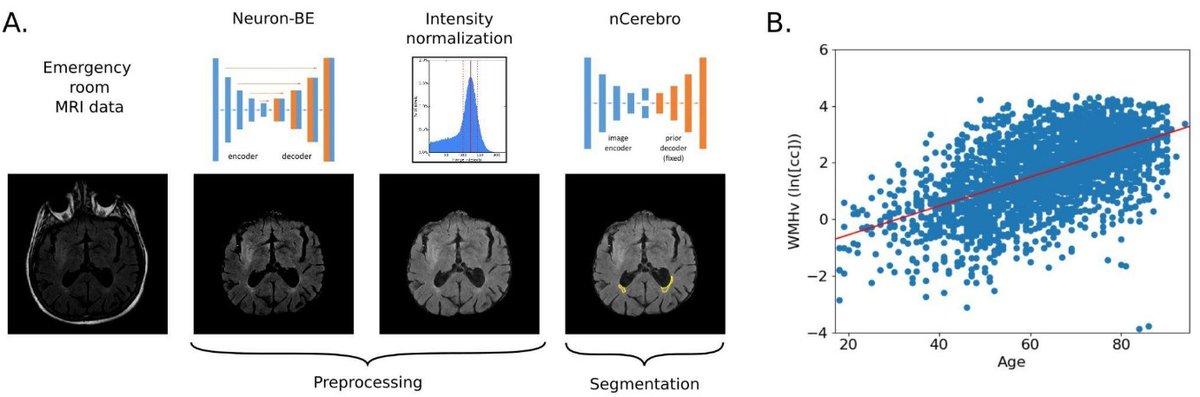 Yesterday during <a href="/StrokeGenetics/">ISGC</a> pre-meeting, we announced the public release of our fully automated white matter hyperintensiy segmentation pipeline for acute ischemic #stroke patients, which allows quantification of chronic small vessel disease burden in clinical FLAIR images
