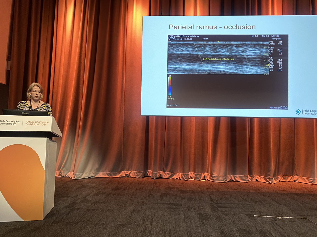 Currently delving into the transformational role of ultrasound scanning where we'll be outlining how it aids in swift diagnosis and treatment of patients with inflammatory arthritis. Pictured: Georgina Ducker covering ultrasound in GCA. #BSR24