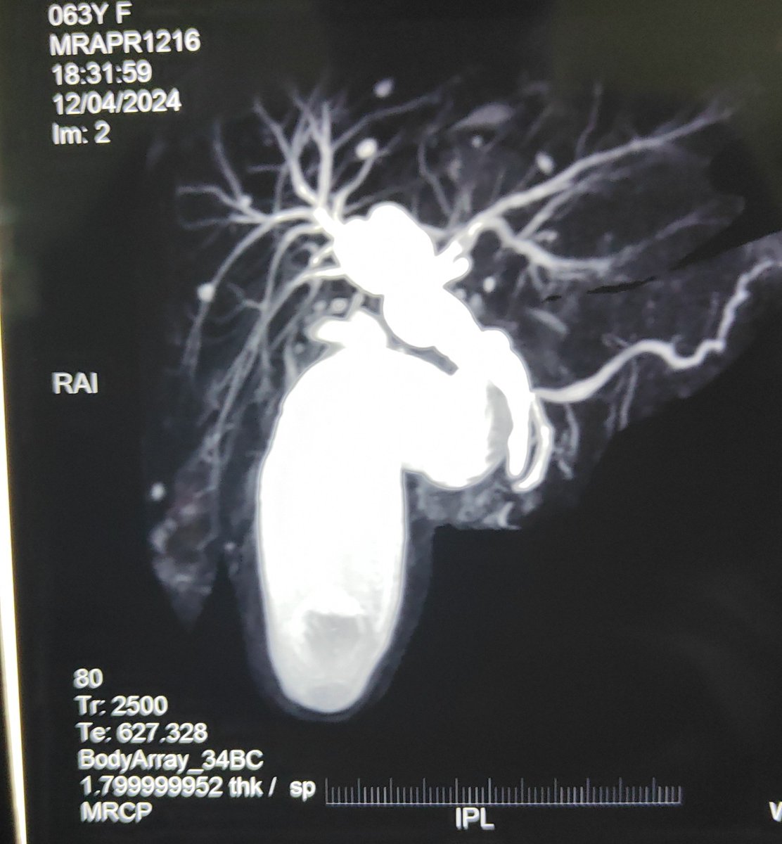 Last Lap cholecystectomy of April. This GB was palpable till right iliac fossa.