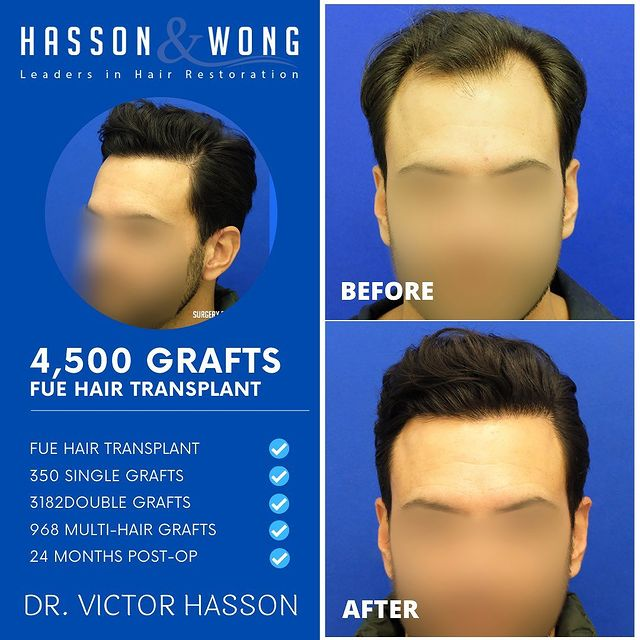 Hasson & Wong - a top 10 hair clinics of ALL TIME according to HairSite.com patient result statistics over a 10 yr period. Free cost esimates with H&W and up to 20 other clinics worldwide with 1 click bit.ly/3VQc8n3 #trending #LockHimUp #MIvsCSK #Beychella