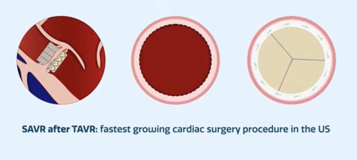 🔥New #SAVR After #TAVR Risk Calculator @STS_CTsurgery

#StructuralHeart🫀
#TAVRExplant🚨

@IbrahimSultanMD @DSGMD @KendraGrubb @GilbertTangMD @JordanBloomMD @AWeymannMD @DrMoritzWvB @NimeshDesaiMD @AortaSurg @KimberlyHolstMD @ScottGoldmanMD @rafasadaba 

m.youtube.com/watch?v=aJ6MKW…