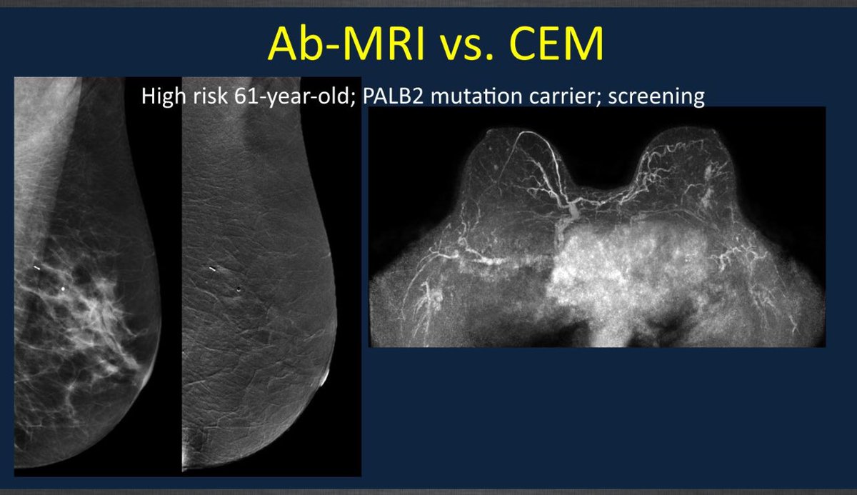 Abbreviated Breast MRI (Ab-MRI) & Contrast-Enhanced Mammography (CEM) are both excellent supplemental screening tests for women with dense breast tissue & an intermediate/average risk of breast cancer, also those with a personal history of BC. Both much quicker & cheaper.