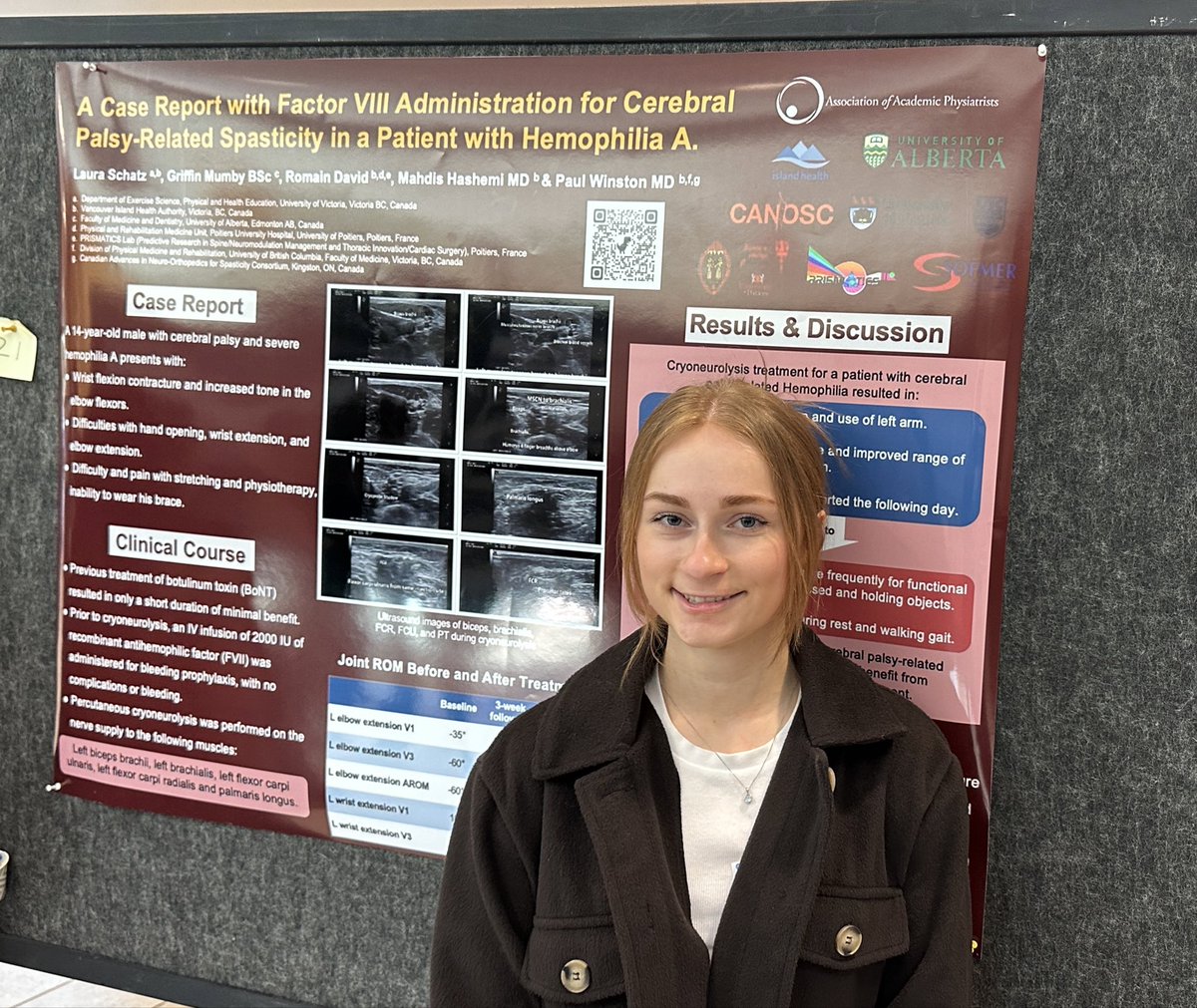 Laura Schatz new @uvic kinesiology grad with her award winning poster. Multisite treatment of a teenager with hemorrhagic hemiplegia due to hemophilia with #cryoneurolysis to prevent frequent injections. #safety