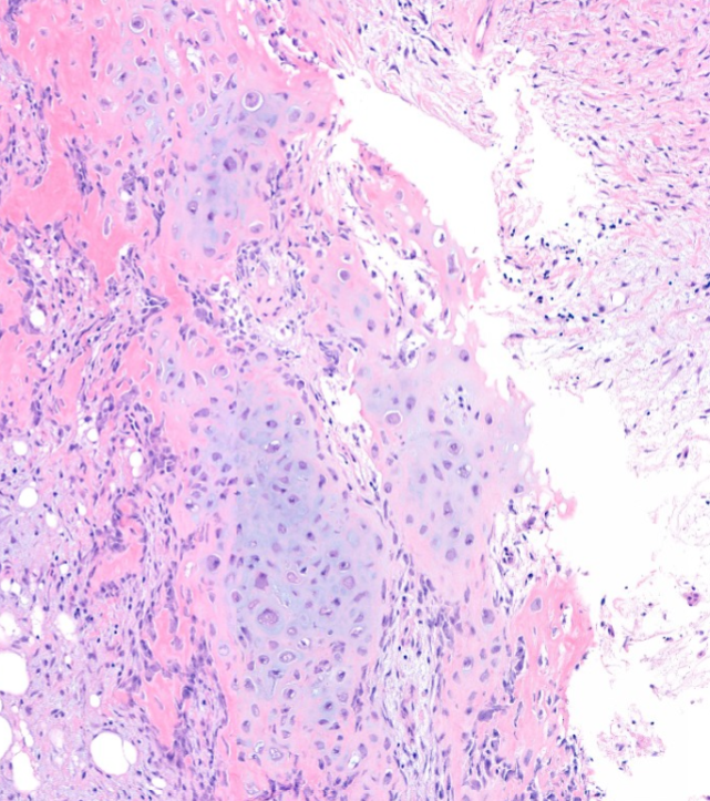#EverydayBST
Elbow mass
Diagnosis?
See answer 👇
Dr. Nielsen #USCAP2024 #BSTPath #pathology #PathX #PathTwitter
