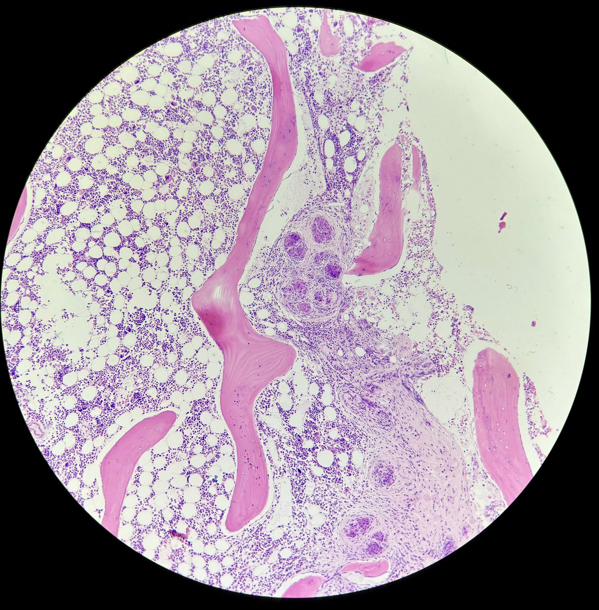 The best granulomas seen in a bone marrow biopsy so far 🟣🟣 #PathTwitter #pathX #pathology #pathresidents #hemepath