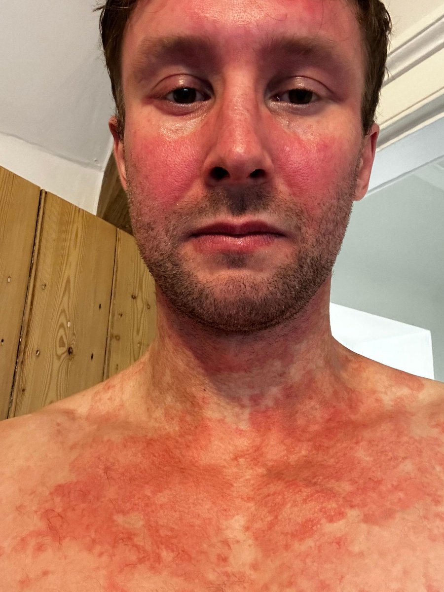 “I’m fortunate to be in a better place now. However, there was a long time where facing the world every day was incredibly difficult.” Living with Atopic Dermatitis has been hard for Andrew, but now he wants to help others facing similar challenges: ow.ly/2XfX50RhUzt