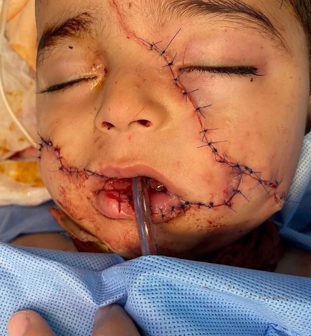 His face was in pieces, they had to stitch it back together, Meanwhile Netanyahu is eyeing his real estate. #Gaza