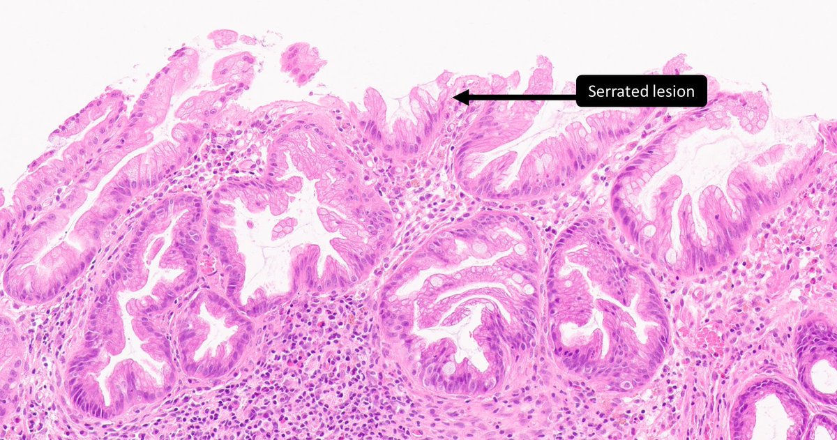 Serrated sigmoid polyp. Diagnosis? A) Sessile serrated lesion B) Perineurioma C) Schwann cell hamartoma D) Schwannoma #GIPath #BSTPath #PathTwitter #pathology virtualpathology.leeds.ac.uk/slides/library…